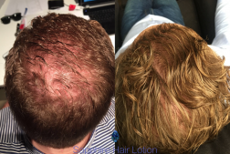 Results before and after applying Sapphire Hair Solution