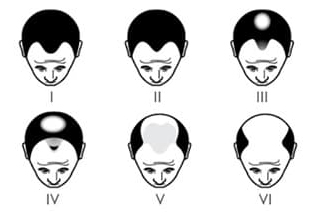 Norwood scale